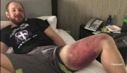 Look: Thiago Silva Wrecked Jared Torgeson's Leg at ACB 51