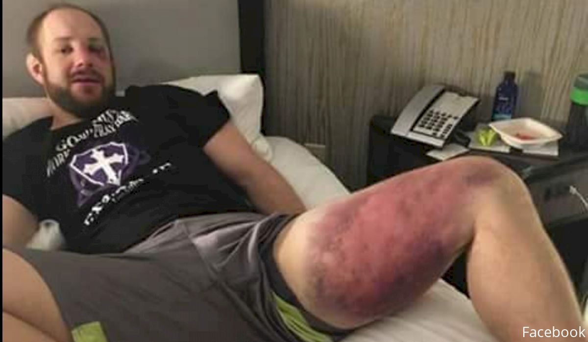Look: Thiago Silva Wrecked Jared Torgeson's Leg at ACB 51