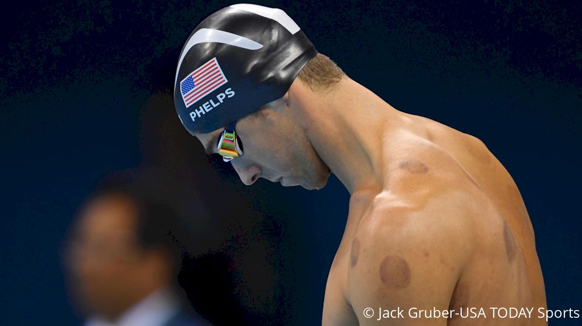 Cupping: Does It Really Accelerate Recovery?