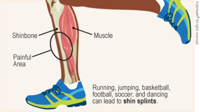 Shin Splint Treatment: How Improving Calf Strength Can Fix Your Shin  Splints - Runners Connect